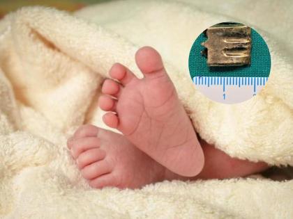 वाडिया रुग्णालयाला मोठं यश, झिपर स्टॉपर गिळलेल्या १० महिन्याच्या बाळाला वाचवलं!
