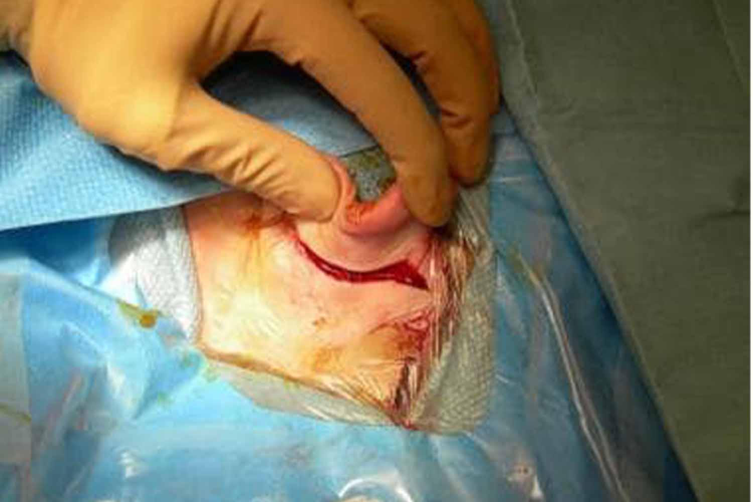 Get the best Cochlear Implant and BAHA Surgery services at Earth ENT Clinic in Sion, Mumbai by top ENT Surgeons & Specialists Dr. Balagopal Kurup and Dr. Srinidhi Ravi